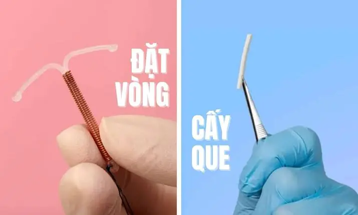 So sánh các biện pháp tránh thai: que cấy, vòng tránh thai, thuốc…