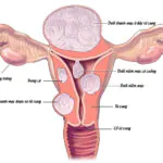 U xơ tử cung: nguyên nhân, triệu chứng, hướng điều trị