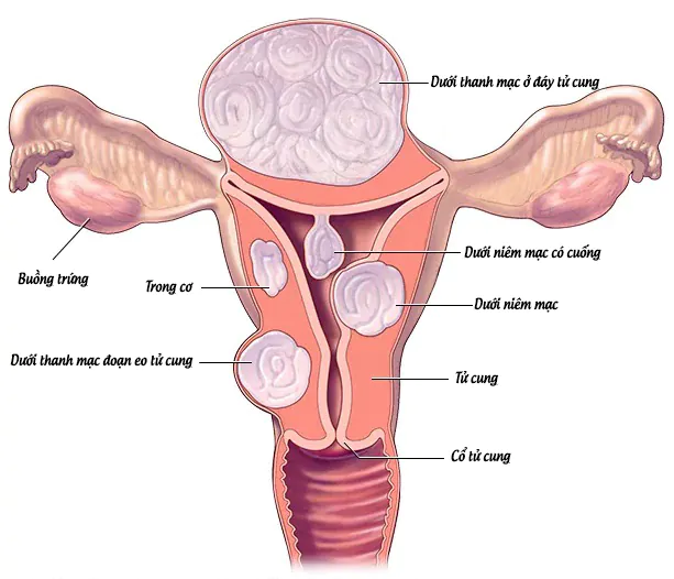 U xơ tử cung: nguyên nhân, triệu chứng, hướng điều trị